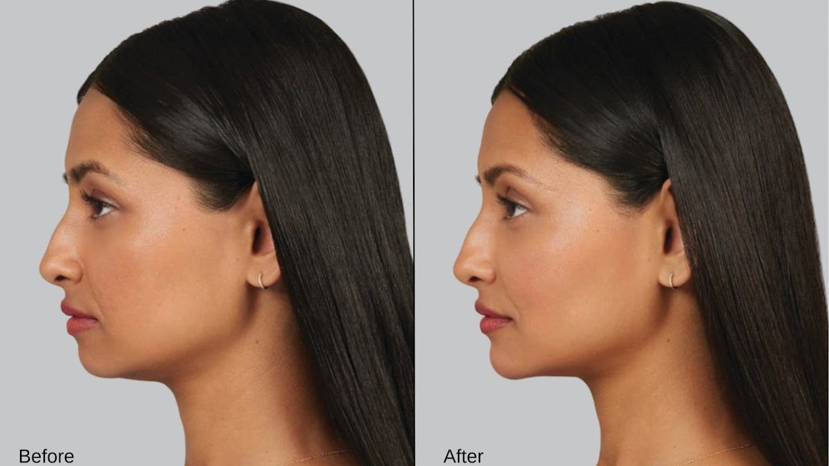 Chin Before & After Gallery - Patient 359687 - Image 1
