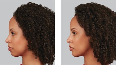 Chin Before & After Gallery - Patient 307695 - Image 1