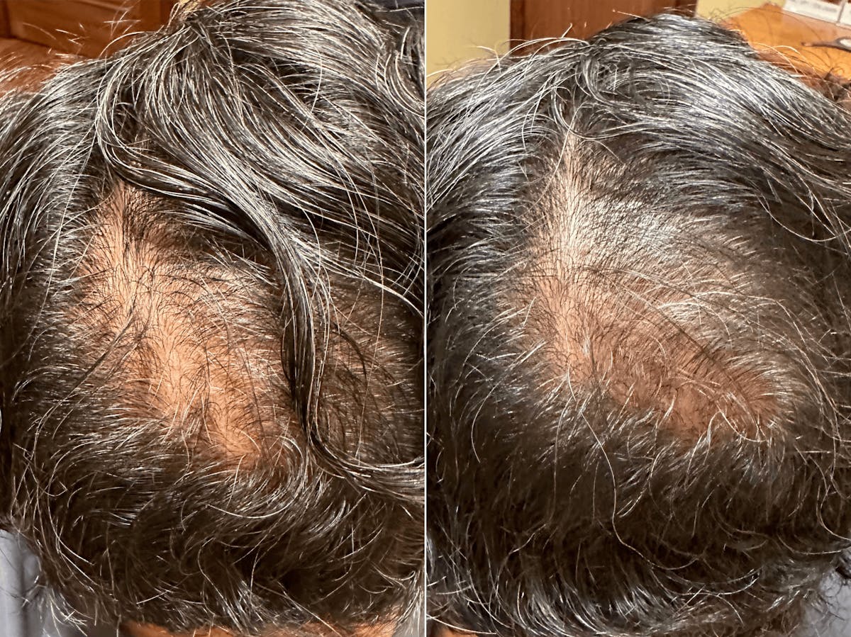 Hair Loss Before & After Gallery - Patient 207412 - Image 1