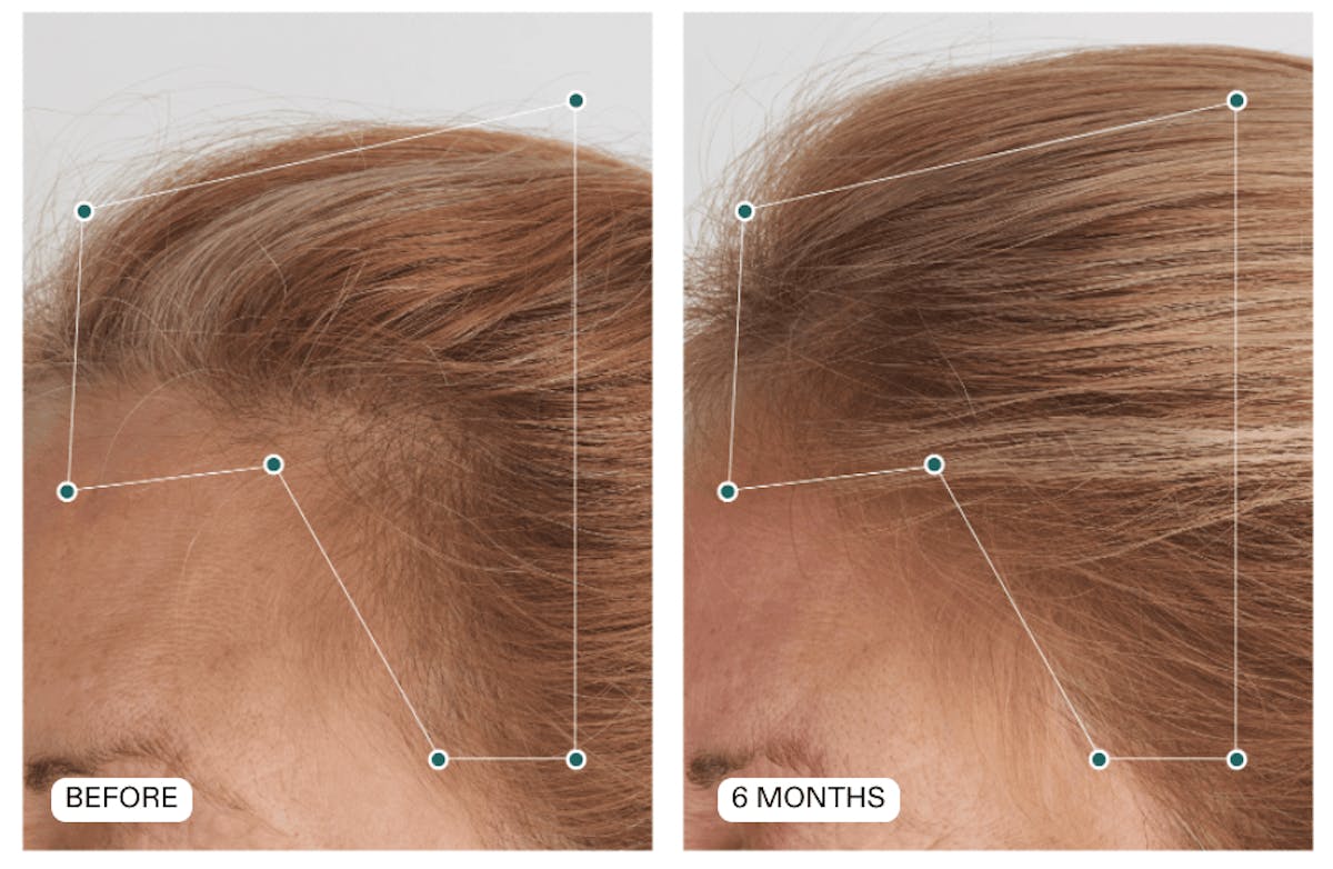Hair Loss Before & After Gallery - Patient 168545 - Image 1