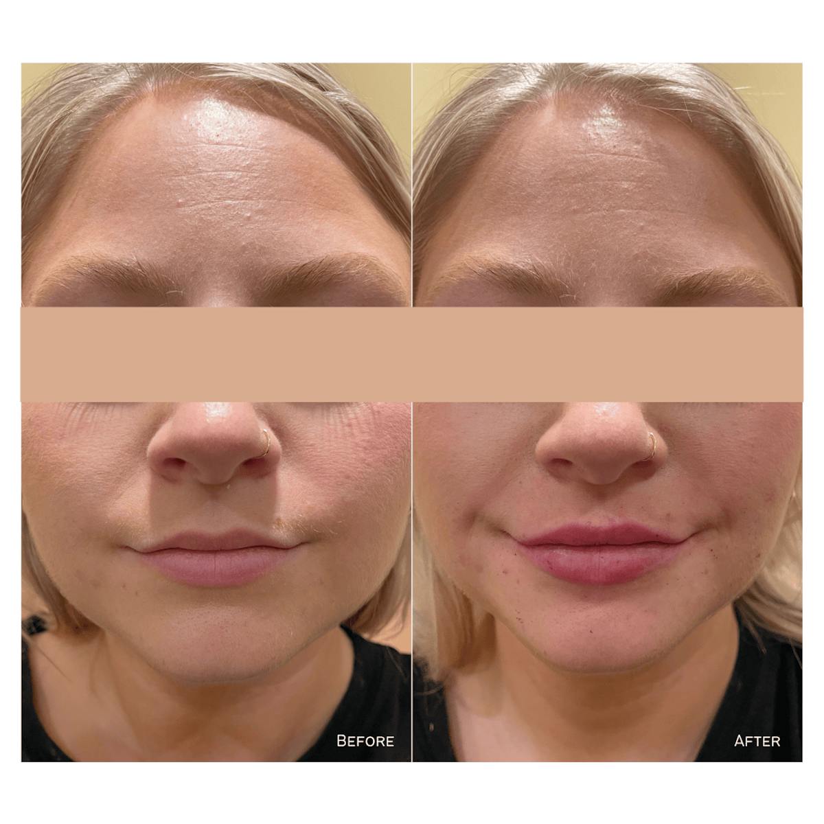 Lips Before & After Gallery - Patient 779114 - Image 1