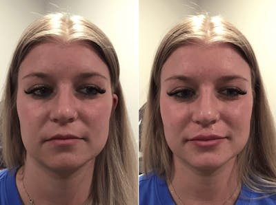 Volbella Before & After Gallery - Patient 141723 - Image 1