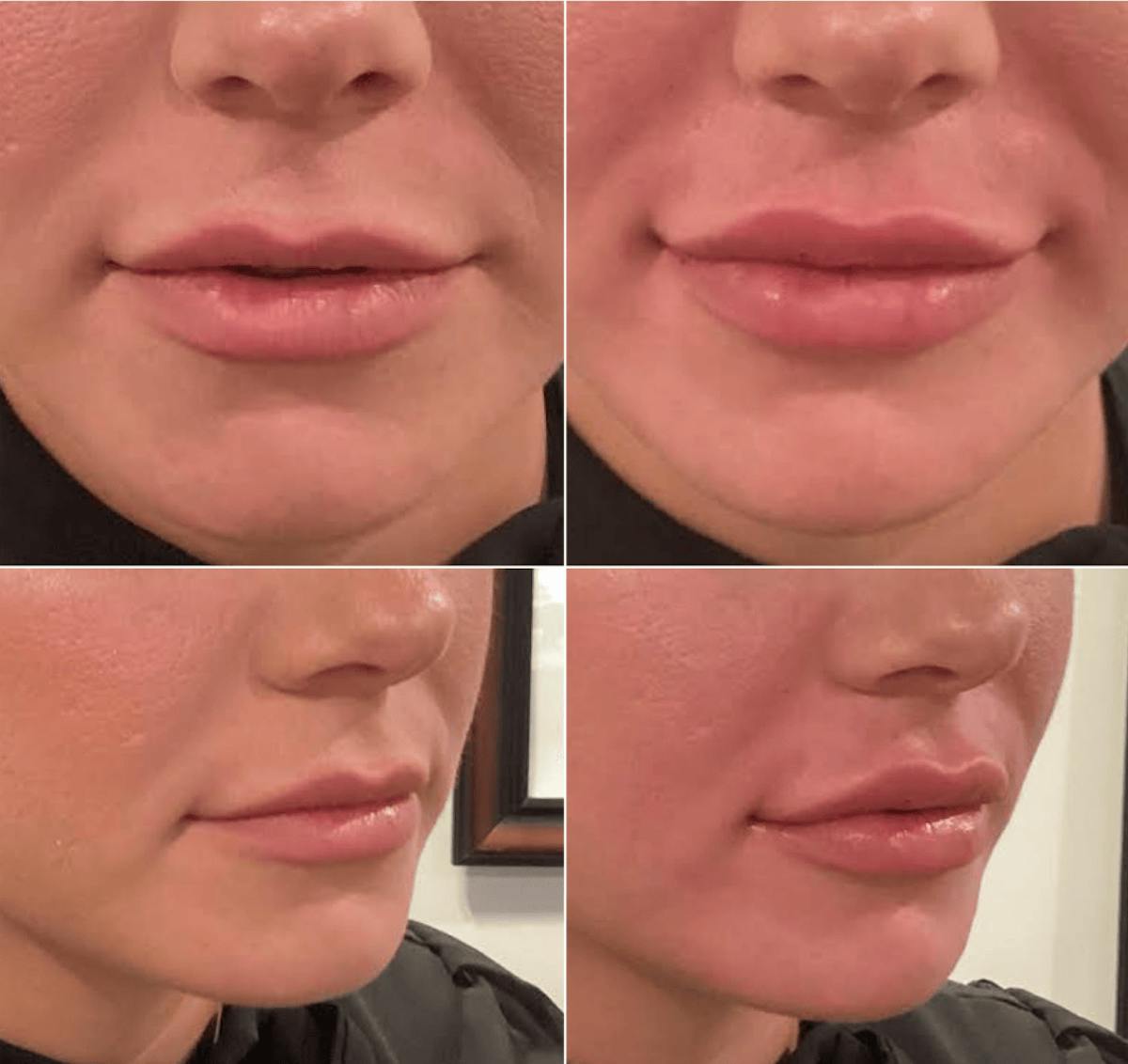 Lips Before & After Gallery - Patient 202316 - Image 1