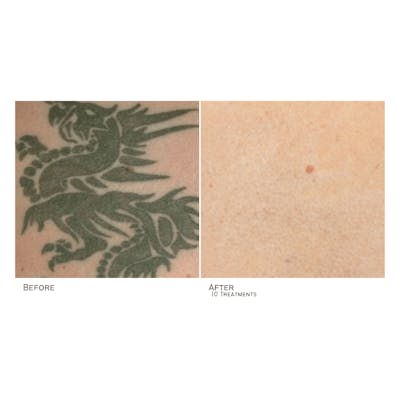 Tattoo Removal Before & After Gallery - Patient 720403 - Image 1