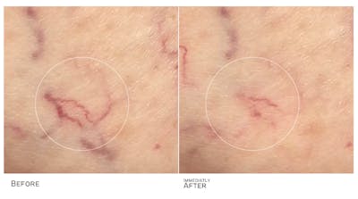 Vein Treatment Before & After Gallery - Patient 425442 - Image 1