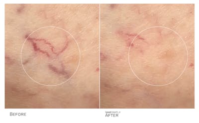 Vein Treatment Before & After Gallery - Patient 177413 - Image 1