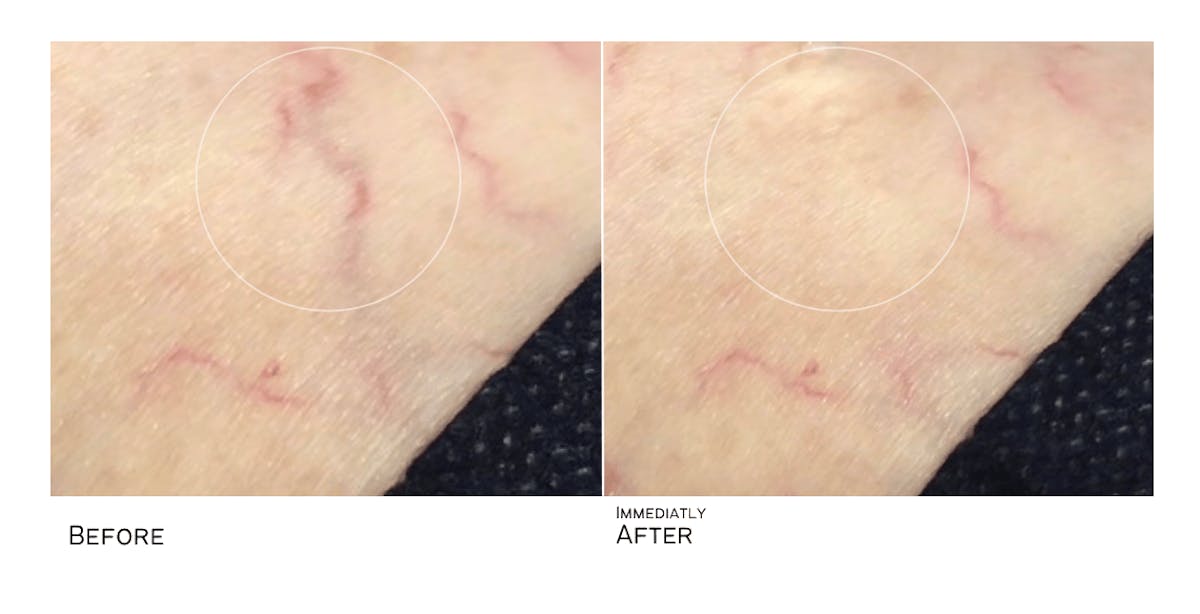 Vein Treatment Before & After Gallery - Patient 398812 - Image 1