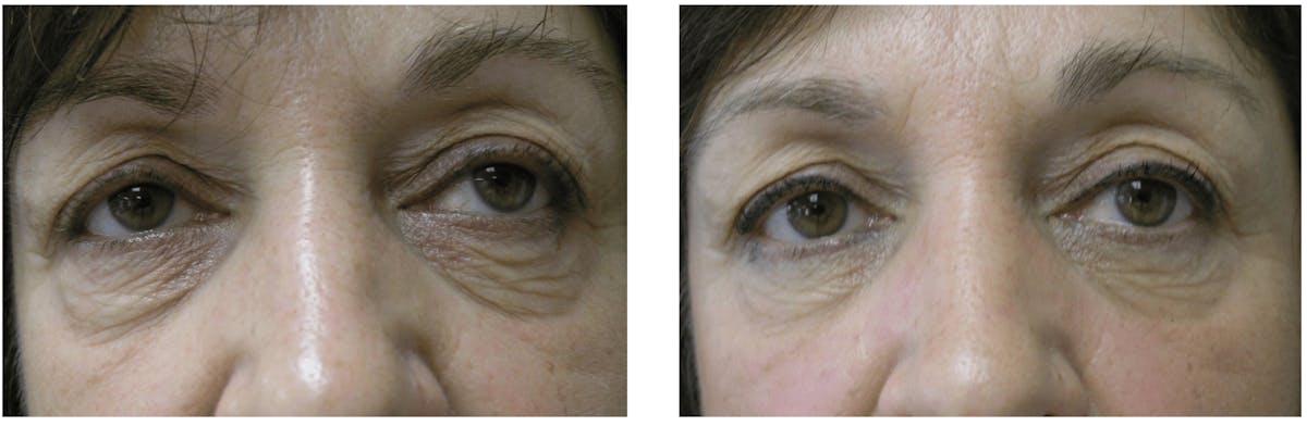 Laser Resurfacing Before & After Gallery - Patient 247627 - Image 1