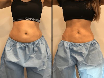 CoolSculpting Before & After Gallery - Patient 193323 - Image 1