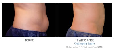 CoolSculpting Before & After Gallery - Patient 896970 - Image 1