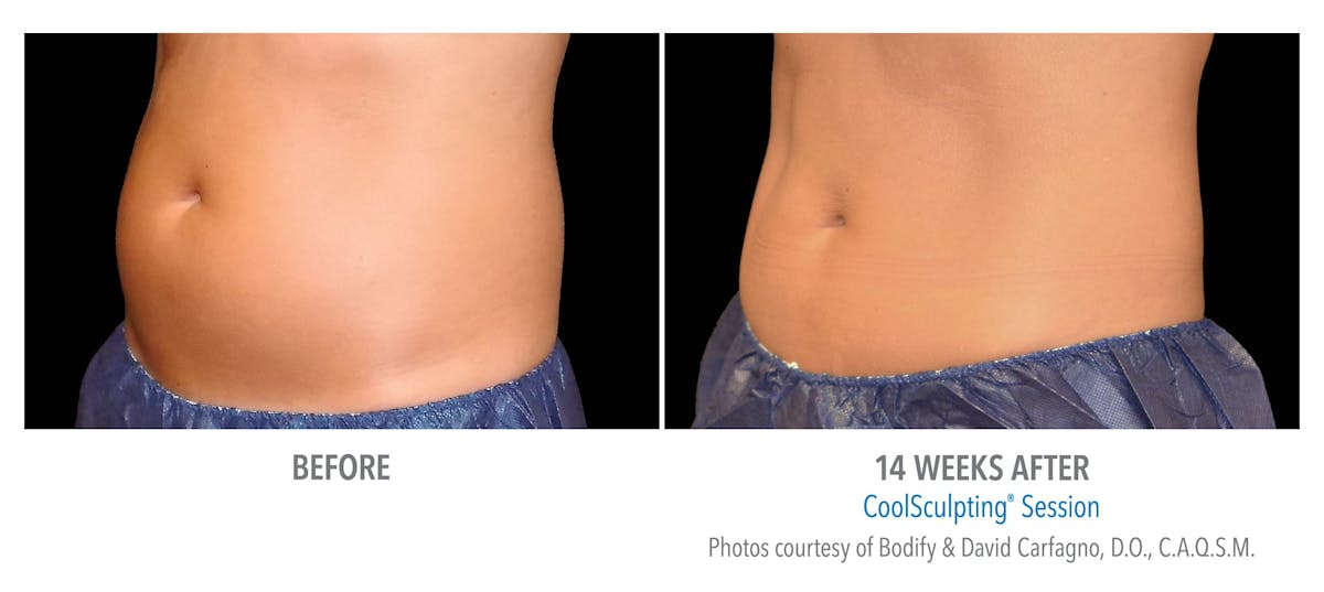 CoolSculpting Before & After Gallery - Patient 896970 - Image 2
