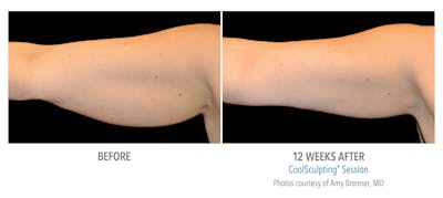 CoolSculpting Before & After Gallery - Patient 169097 - Image 1