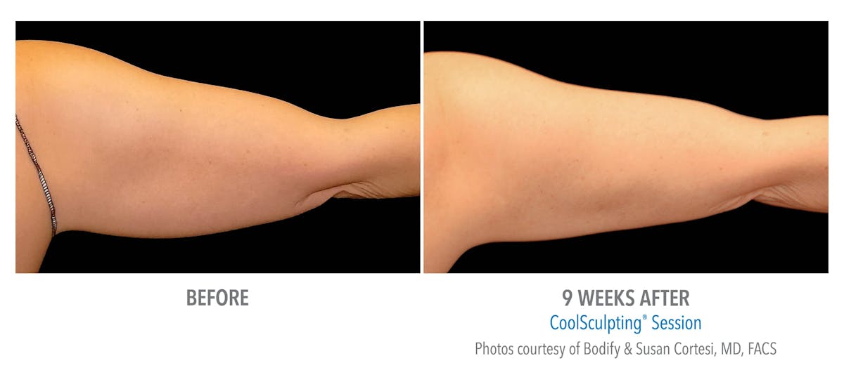 CoolSculpting Before & After Gallery - Patient 169097 - Image 2