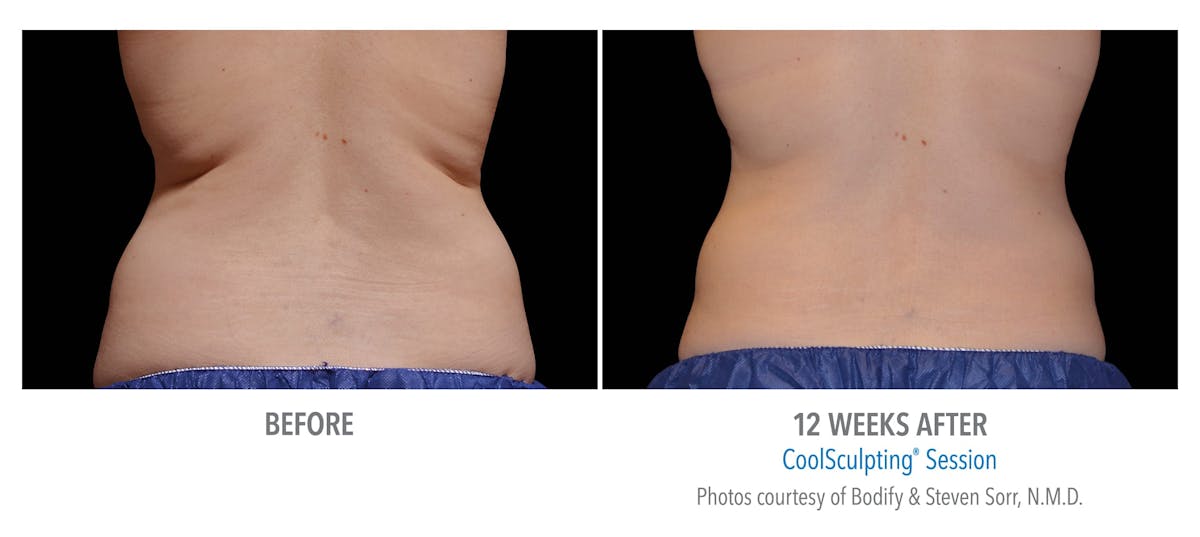 CoolSculpting Before & After Gallery - Patient 873145 - Image 1