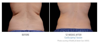 CoolSculpting Before & After Gallery - Patient 873145 - Image 1