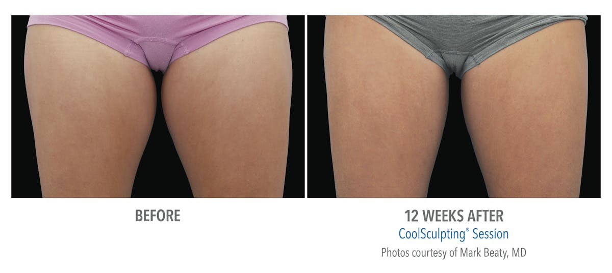 CoolSculpting Before & After Gallery - Patient 312478 - Image 1