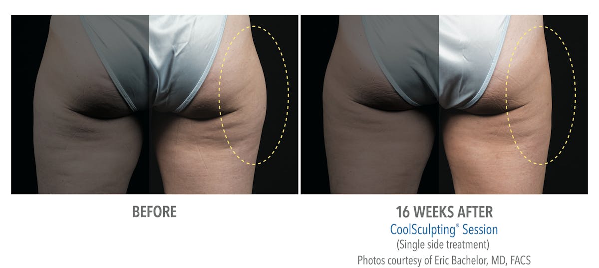 CoolSculpting Before & After Gallery - Patient 308380 - Image 1