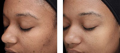 Chemical Peels Before & After Gallery - Patient 264650 - Image 1