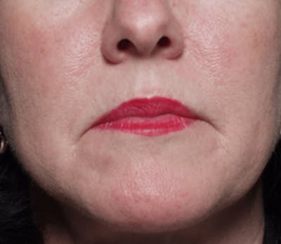 BOTOX Before & After Gallery - Patient 402060 - Image 1