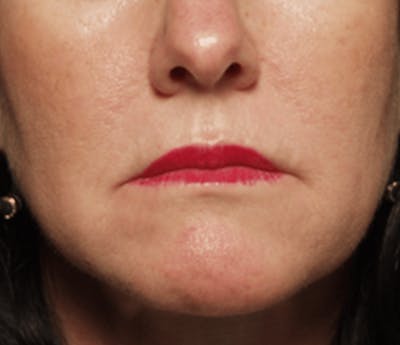 BOTOX Before & After Gallery - Patient 402060 - Image 2