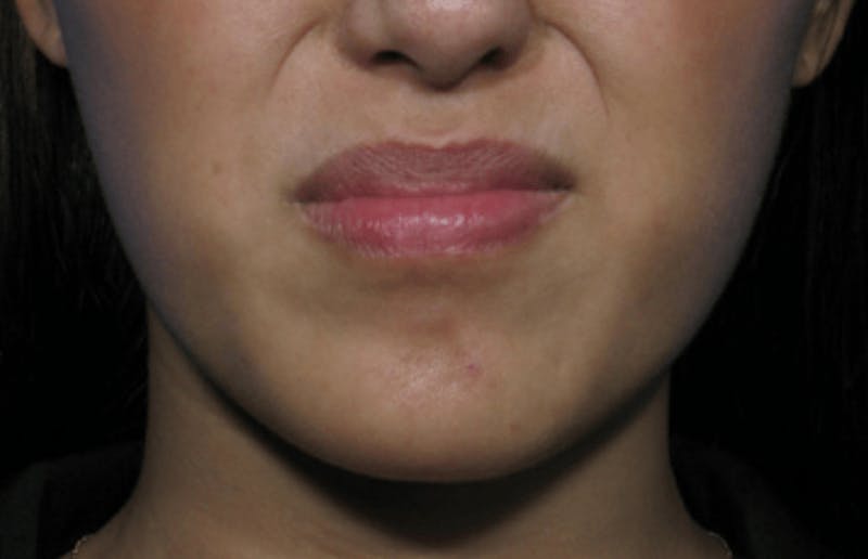 BOTOX Before & After Gallery - Patient 114737 - Image 1