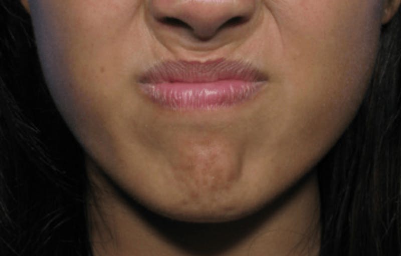 BOTOX Before & After Gallery - Patient 114737 - Image 2