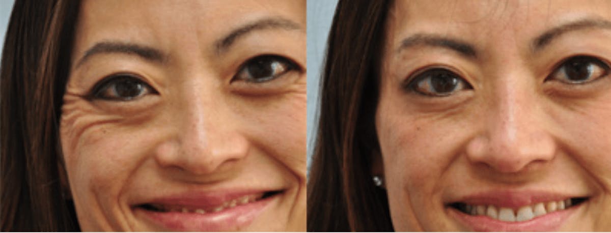 BOTOX Before & After Gallery - Patient 364787 - Image 1