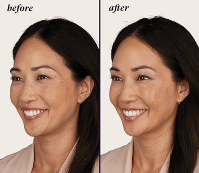 BOTOX Before & After Gallery - Patient 184102 - Image 1