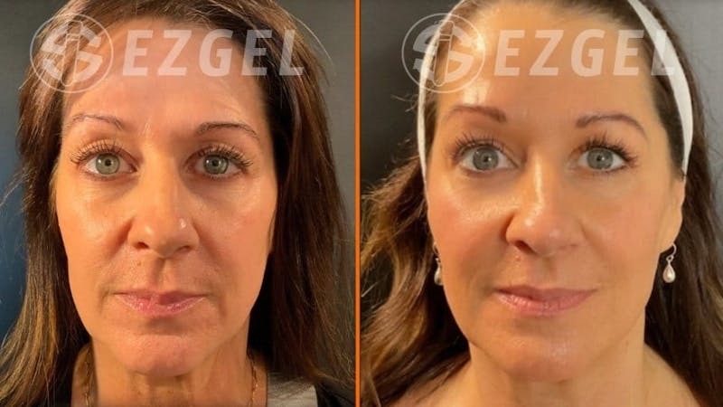 Dermal Fillers Before & After Gallery - Patient 263921 - Image 1
