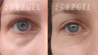 Dermal Fillers Before & After Gallery - Patient 262659 - Image 1