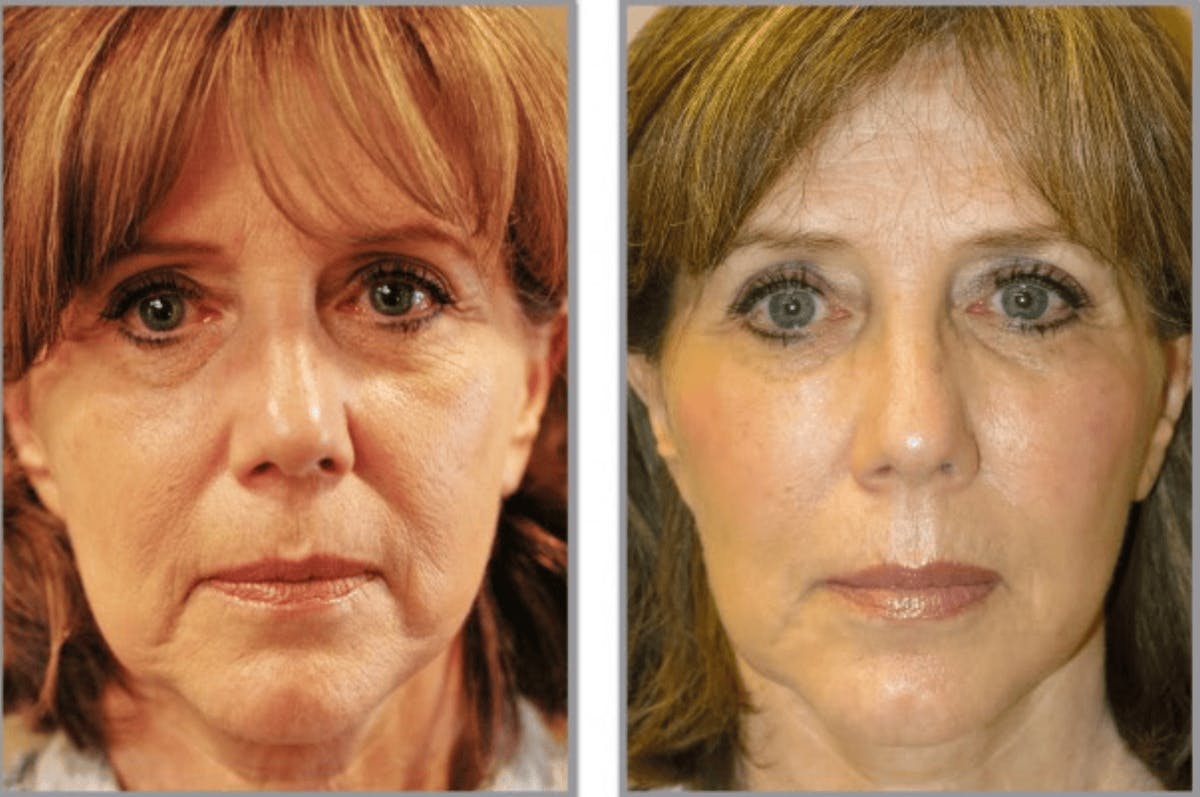 Gel Lift Before & After Gallery - Patient 220277 - Image 1