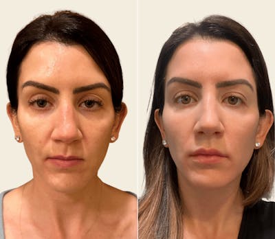 Gel Lift Before & After Gallery - Patient 264160 - Image 1