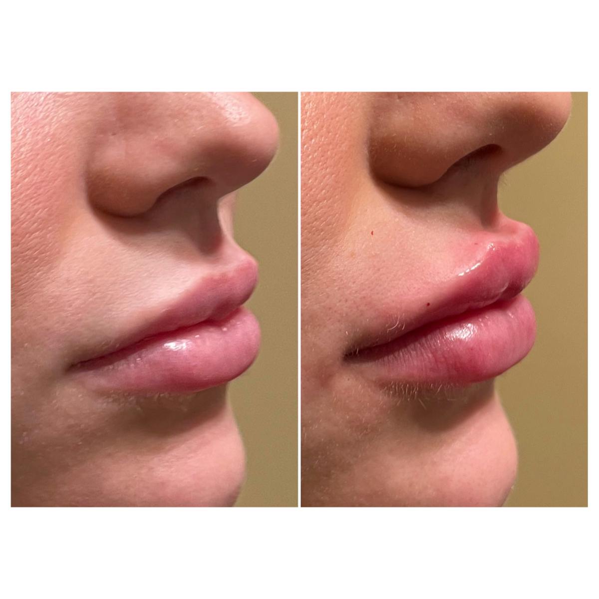 Juvederm Before & After Gallery - Patient 101350 - Image 1