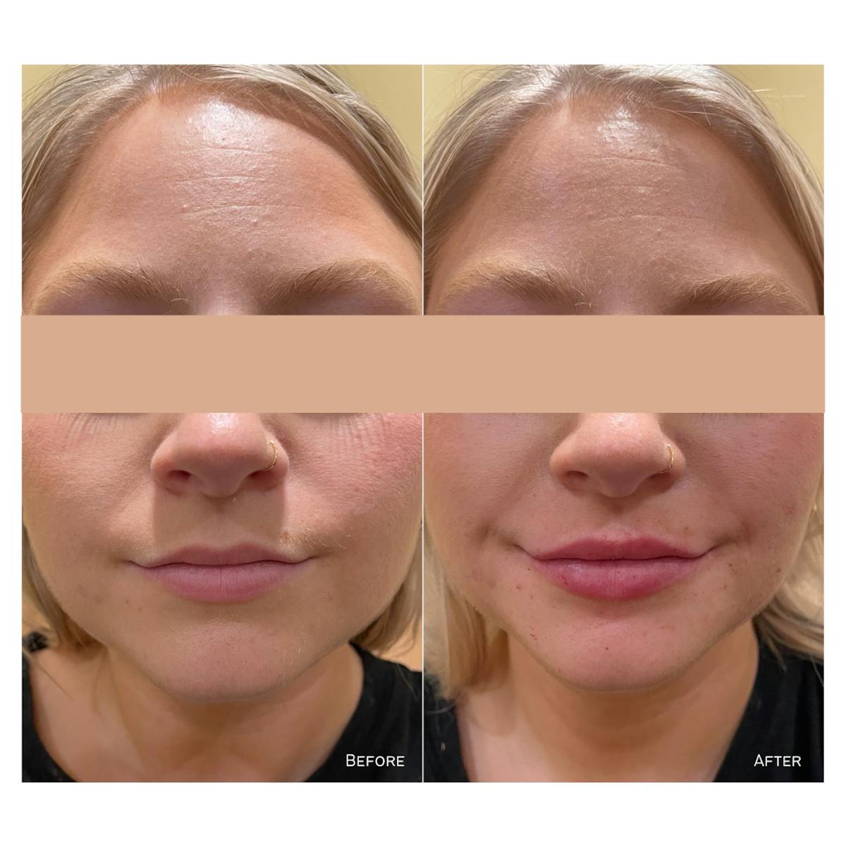 Juvederm Before & After Gallery - Patient 382593 - Image 1