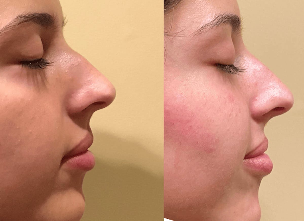 Liquid Rhinoplasty Before & After Gallery - Patient 193702 - Image 1