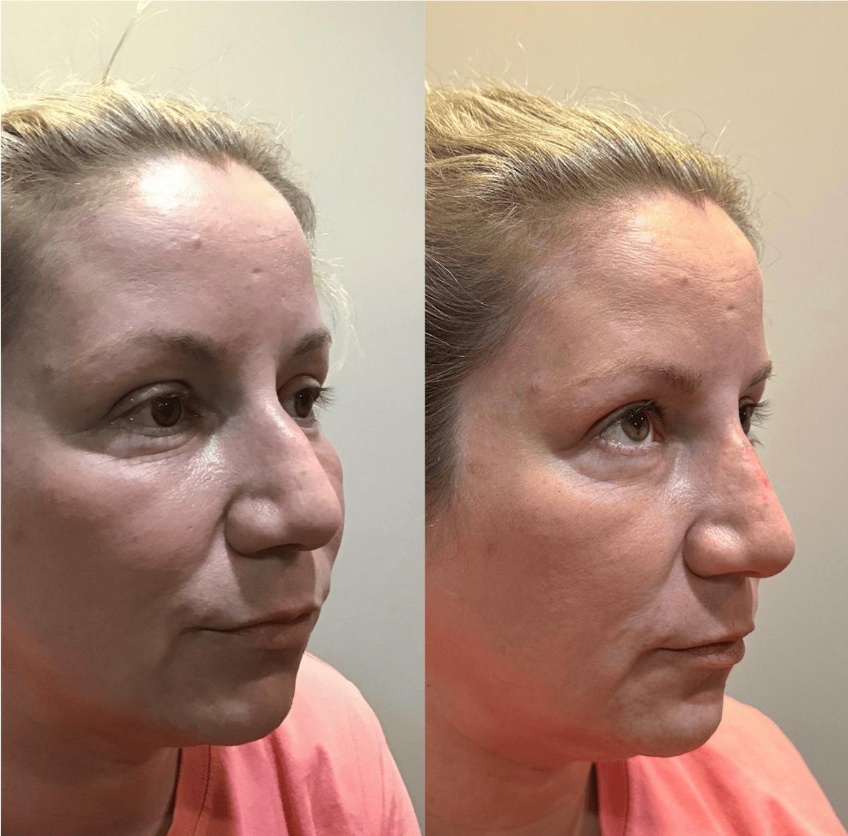 Liquid Rhinoplasty Before & After Gallery - Patient 911253 - Image 1