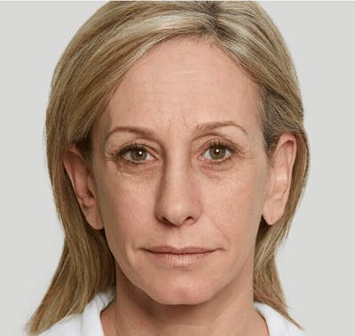 Sculptra Before & After Gallery - Patient 389223 - Image 1