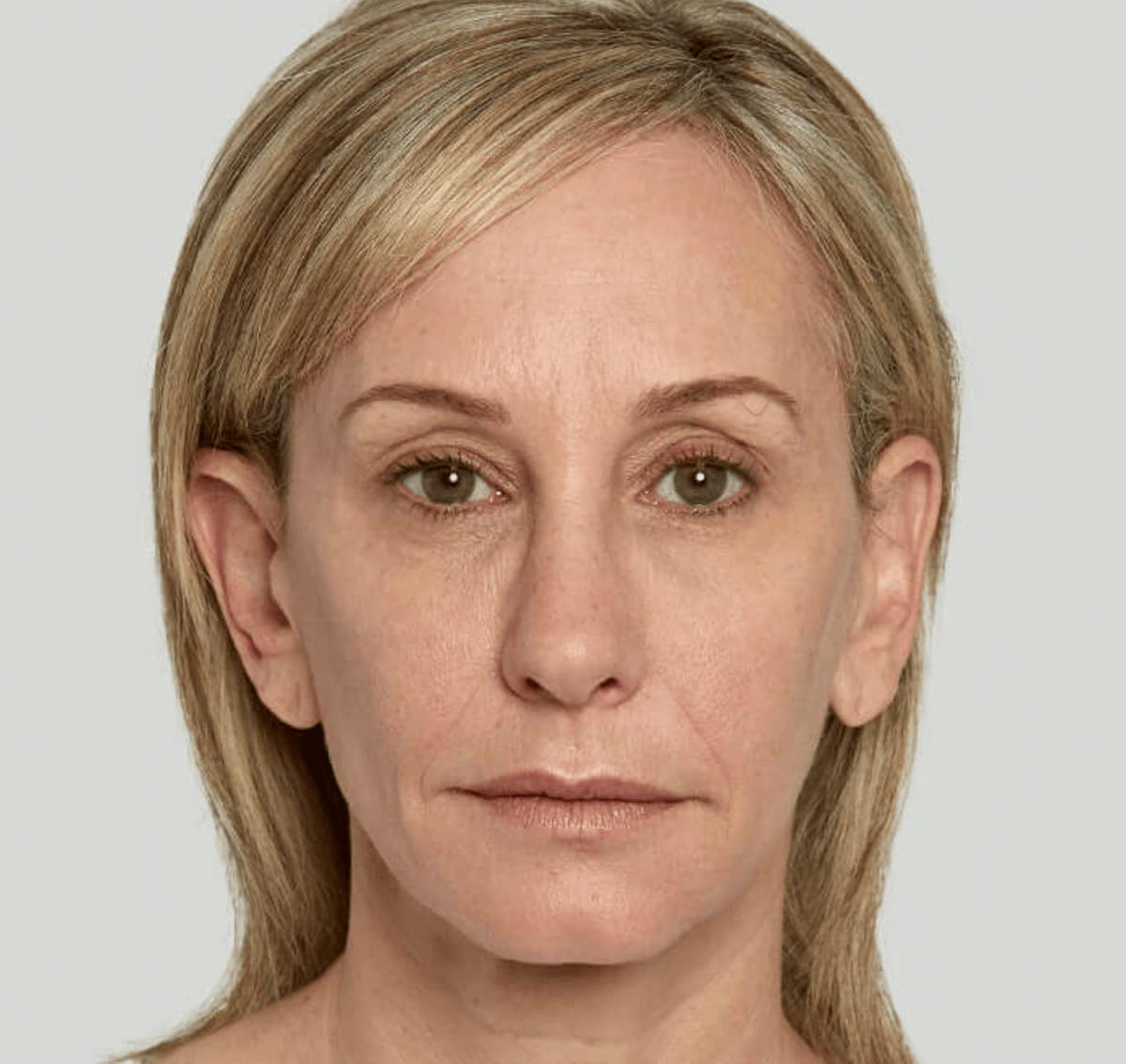 Sculptra Before & After Gallery - Patient 389223 - Image 2