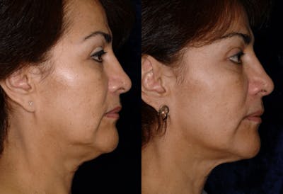 Thermage Before & After Gallery - Patient 323805 - Image 1