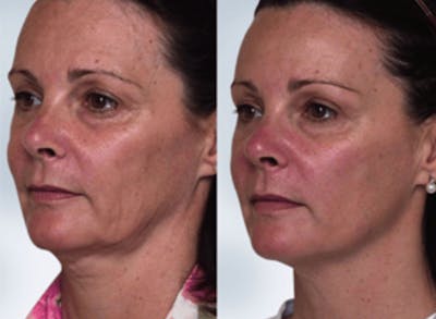 Thermage Before & After Gallery - Patient 279790 - Image 1
