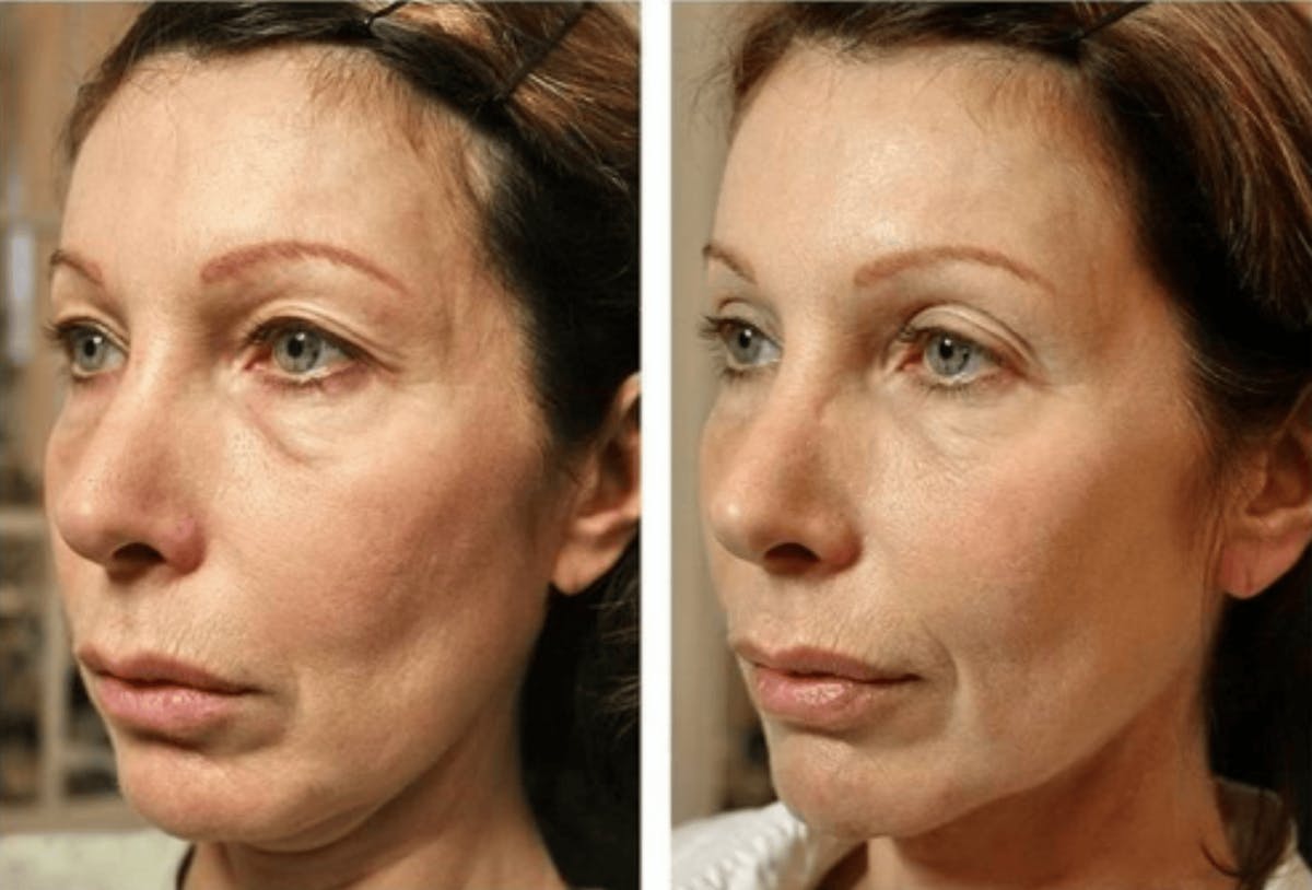Thermage Before & After Gallery - Patient 290811 - Image 1