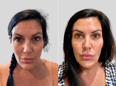 Volbella Before & After Gallery - Patient 295575 - Image 1