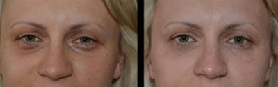Volbella Before & After Gallery - Patient 228332 - Image 1