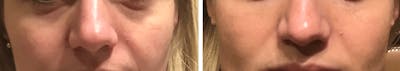 Volbella Before & After Gallery - Patient 132527 - Image 1