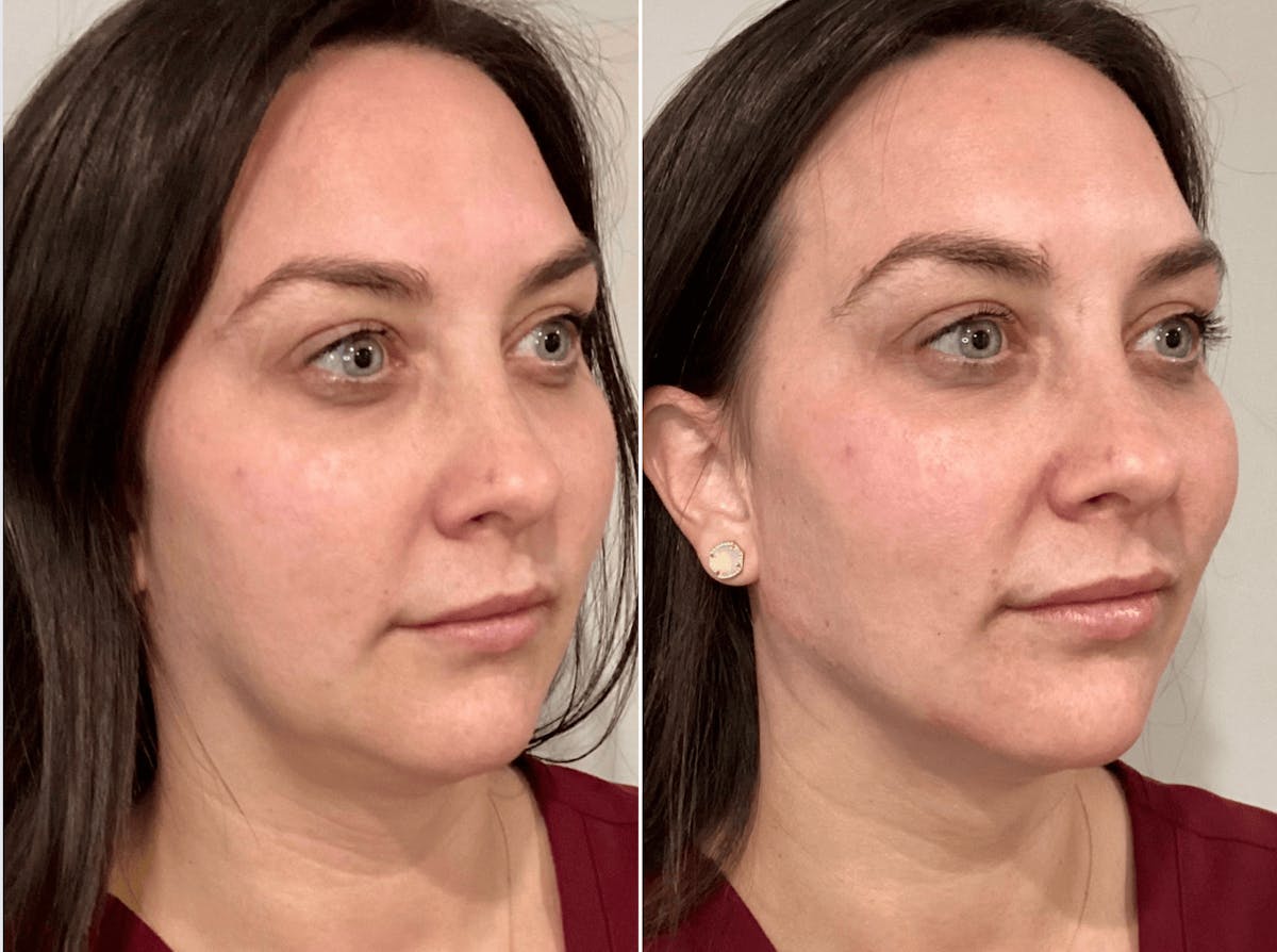 Volux Before & After Gallery - Patient 770461 - Image 2