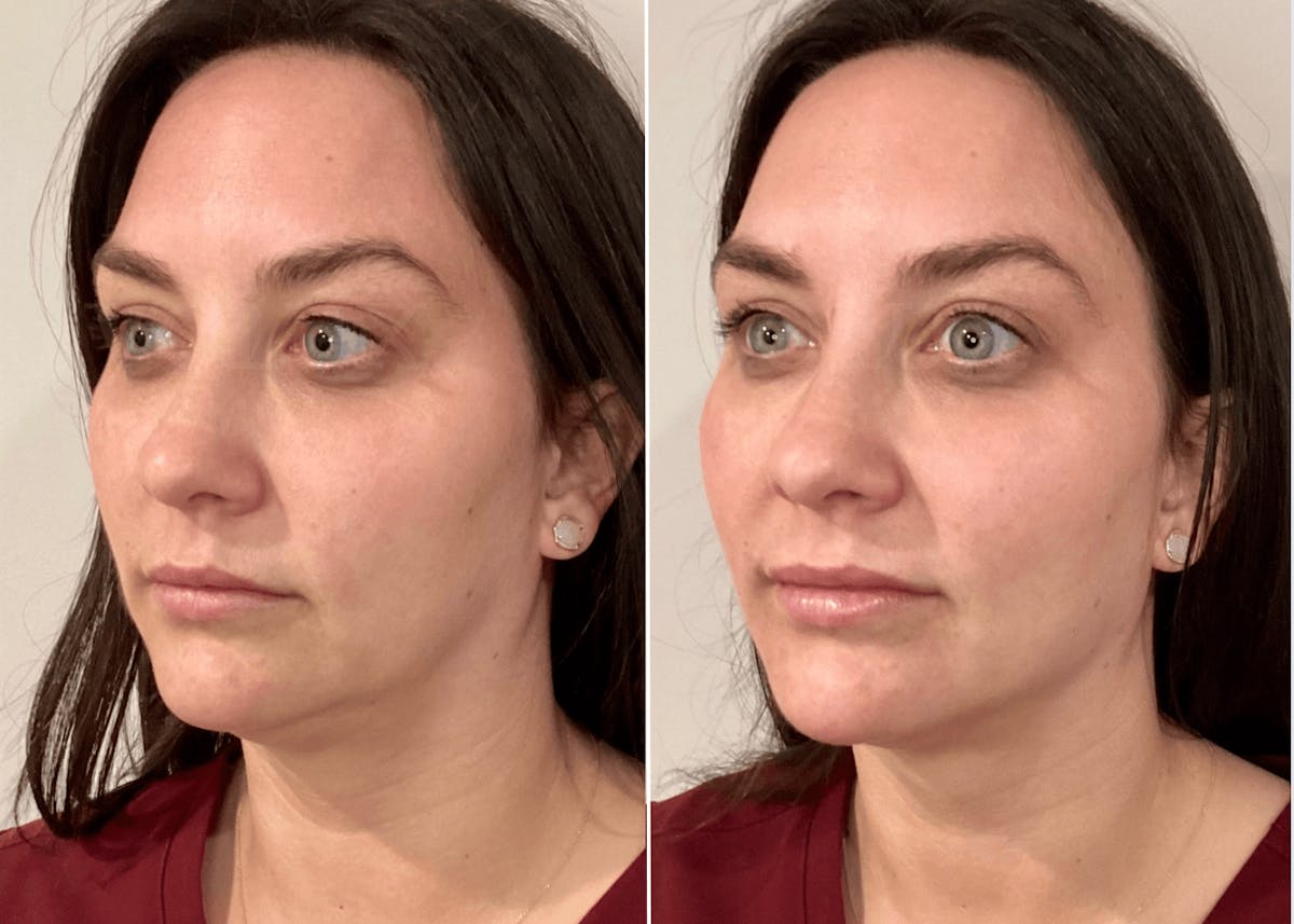 Volux Before & After Gallery - Patient 770461 - Image 1