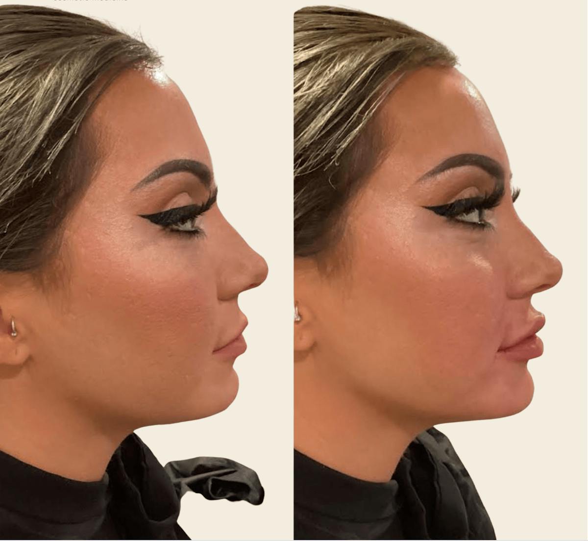 Voluma Before & After Gallery - Patient 412944 - Image 1
