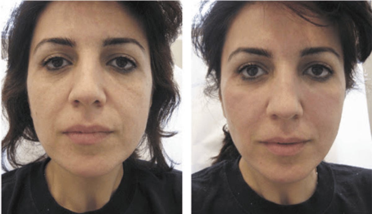 Voluma Before & After Gallery - Patient 370856 - Image 1