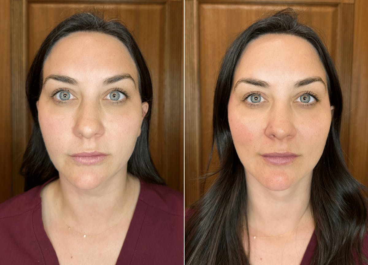 Voluma Before & After Gallery - Patient 837800 - Image 1