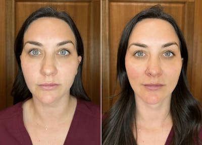 Voluma Before & After Gallery - Patient 837800 - Image 1